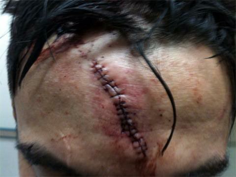 Earlier in the week we showed you the war wound Miguel Torres received from